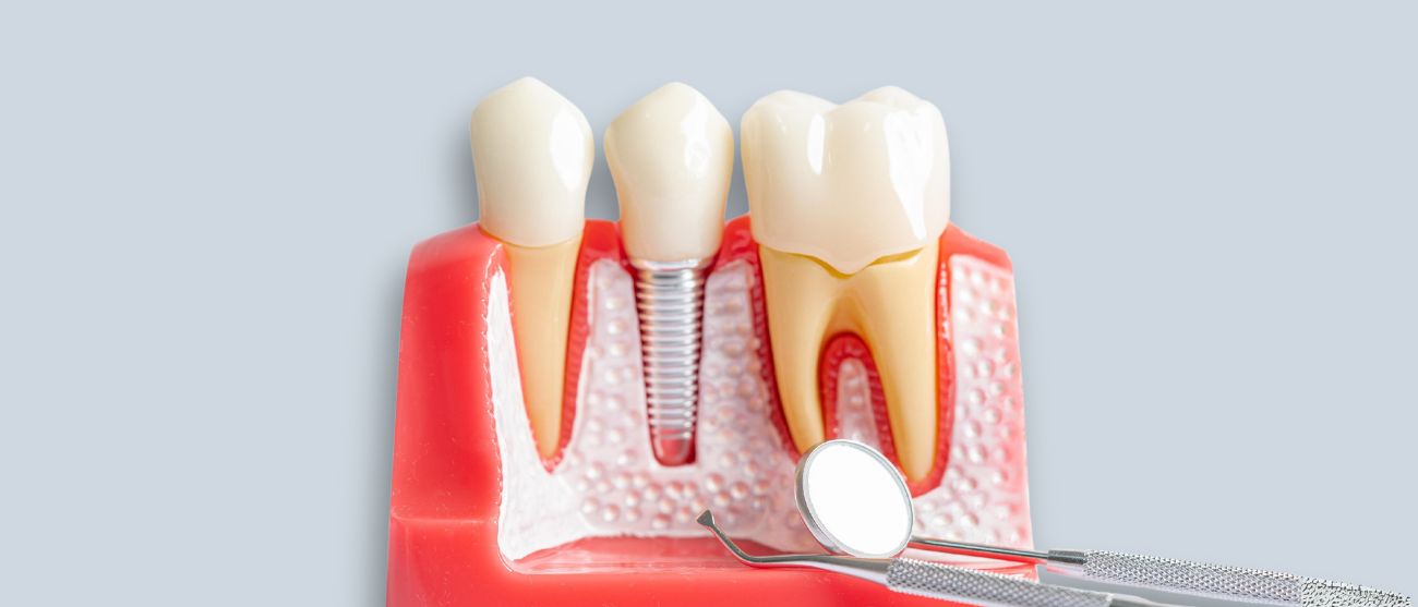 implantologia denti fissi