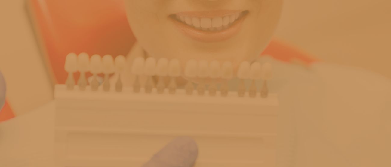 Tre domande che tutti fanno sulle faccette dentali