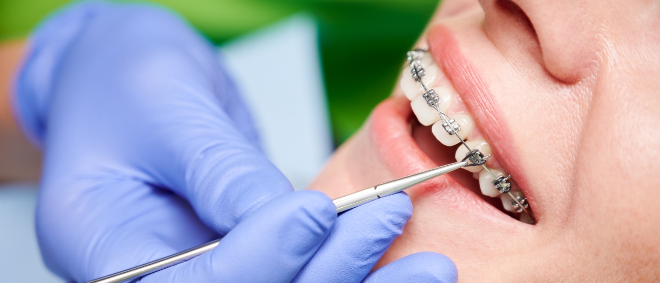 Ragazzi e apparecchio ecco come scegliere la soluzione giusta