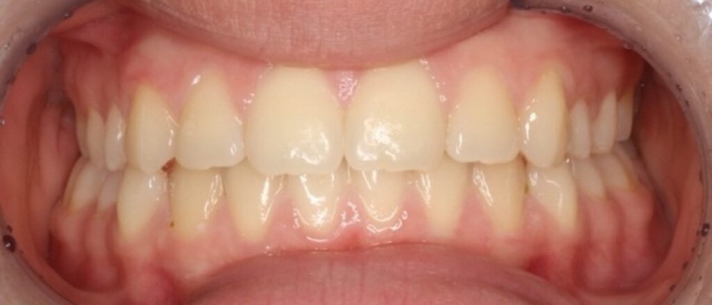 Prima e dopo CMO Zanotto case study ortodonzia intercettiva dopo