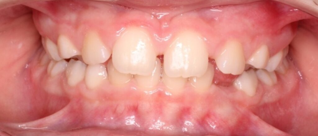 Prima e dopo CMO Zanotto case study ortodonzia intercettiva intermedio