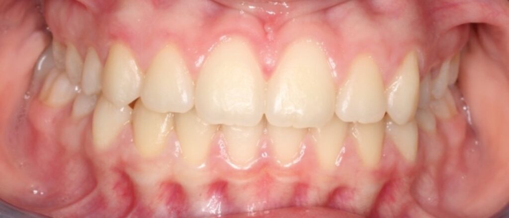 Prima e dopo CMO Zanotto case study ortodonzia intercettiva nuovi