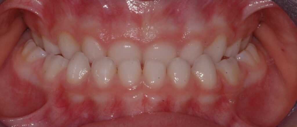 Prima e dopo CMO Zanotto case study ortodonzia intercettiva prima