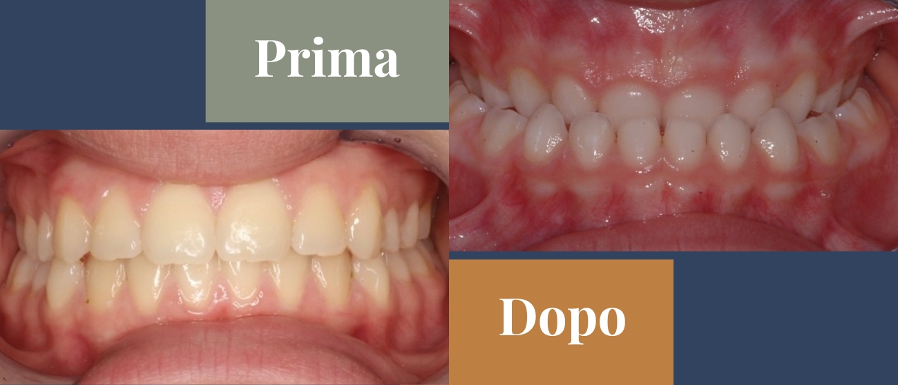 Prima e dopo CMO Zanotto case study ortodonzia intercettiva