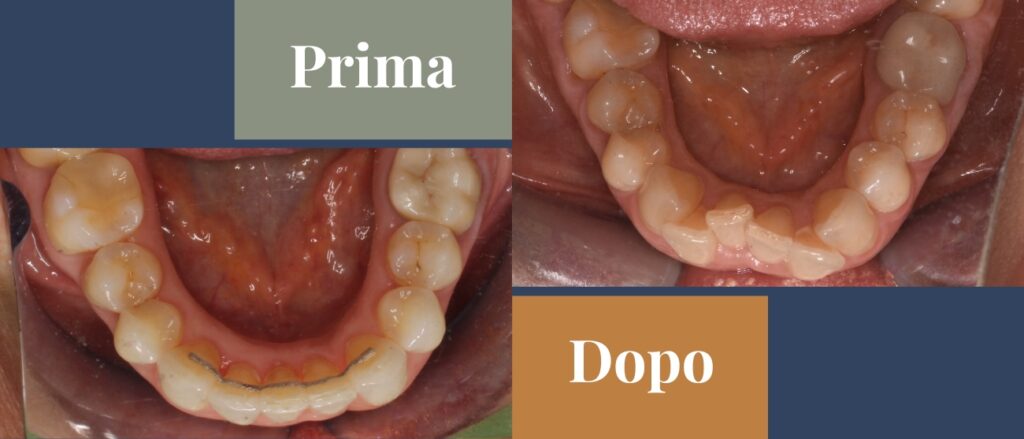 Prima e dopo CMO Zanotto ortodonzia con allineatori caso studio