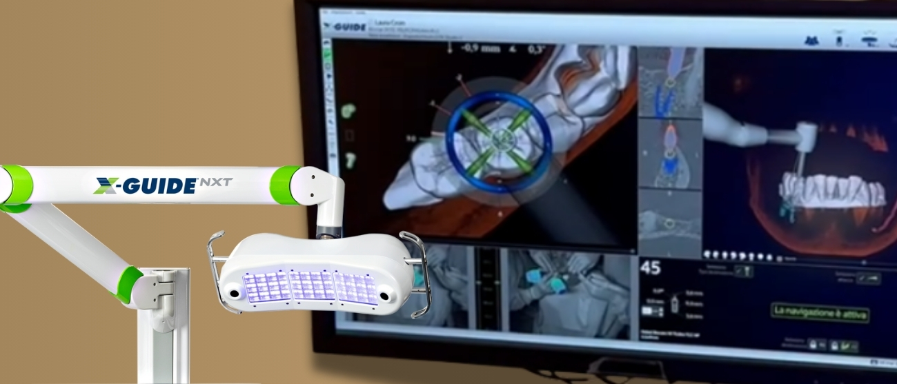 Come si rende l’implantologia più veloce precisa e indolore xguide cmo zanotto
