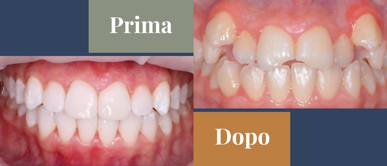 Prima e dopo CMO Zanotto affollamento dentale