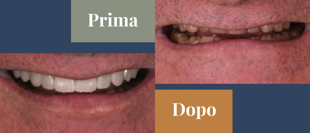 Prima e dopo CMO Zanotto come si riparano i danni da bruxismo