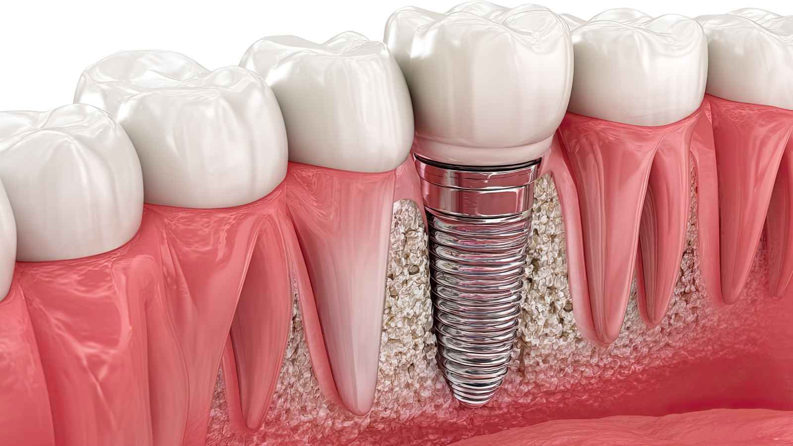 Come funziona la riabilitazione full arch per pazienti senza denti
