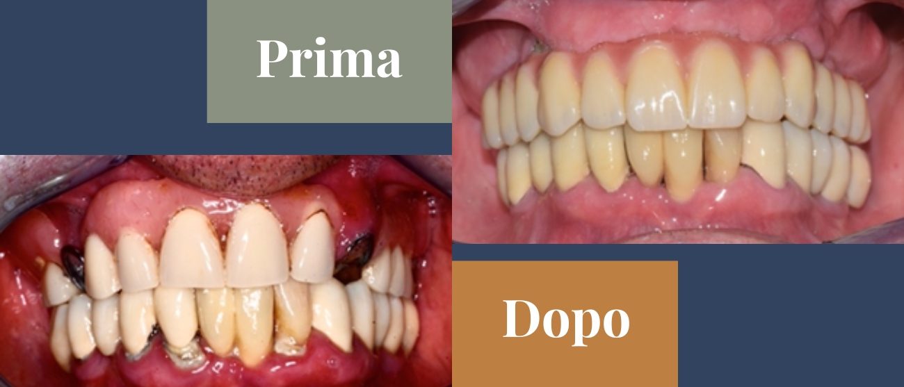 Prima e dopo CMO Zanotto i vantaggi dell’implantologia all on four