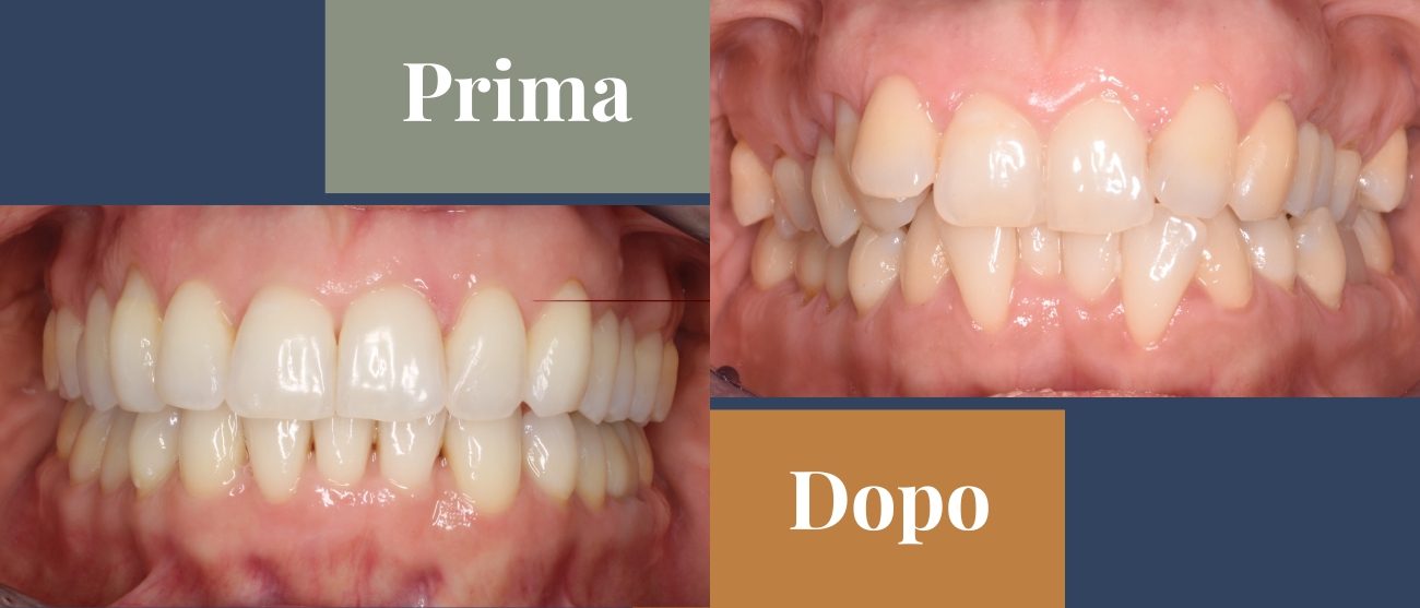Prima e dopo CMO Zanotto ortodonzia con allineatori